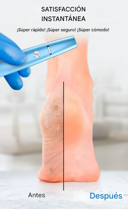 Eliminador de Callos Eléctrico Recargable - SOFTFEET PRO™
